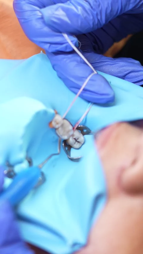 Dental Procedure in Progress Stock Footage 316915186