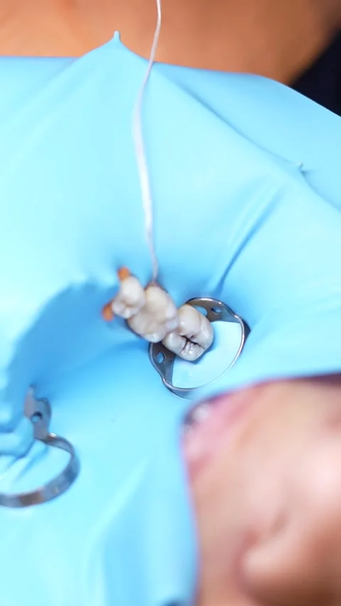 Dental Procedure in Progress Stock Footage 316915290