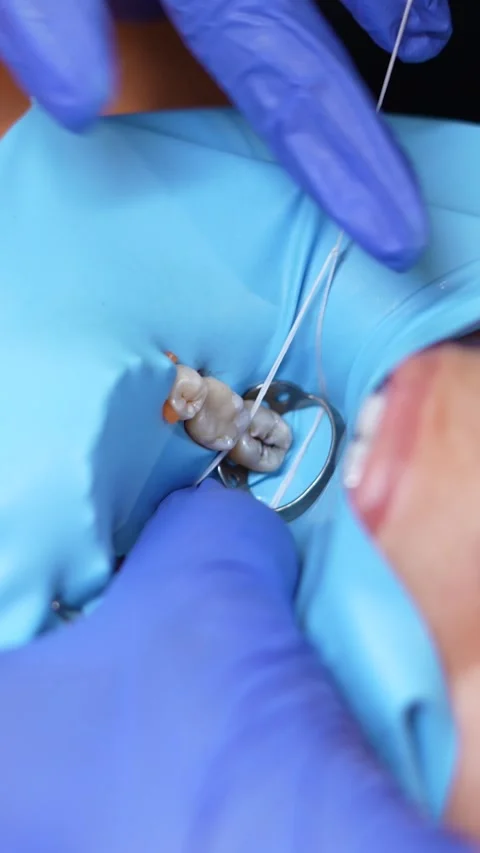 Dental Procedure in Progress Stock Footage 316915468