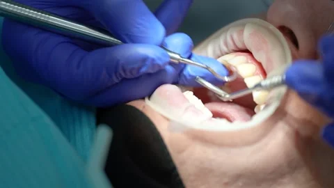 Dental Procedure in Progress Stock Footage 316916192