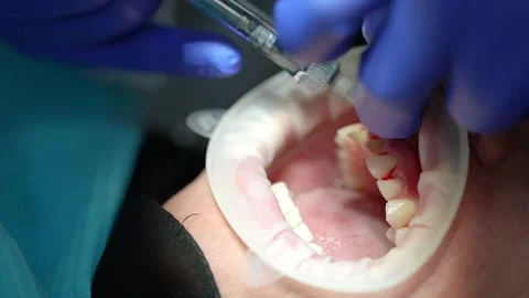 Dental Procedure in Progress Stock Footage 316916470