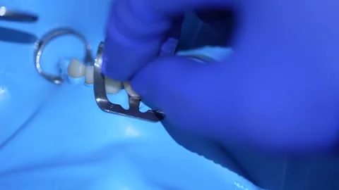 Dental Procedure in Progress Stock Footage 316917362