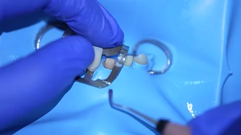 Dental Procedure with Prosthetics Stock Footage 316917334