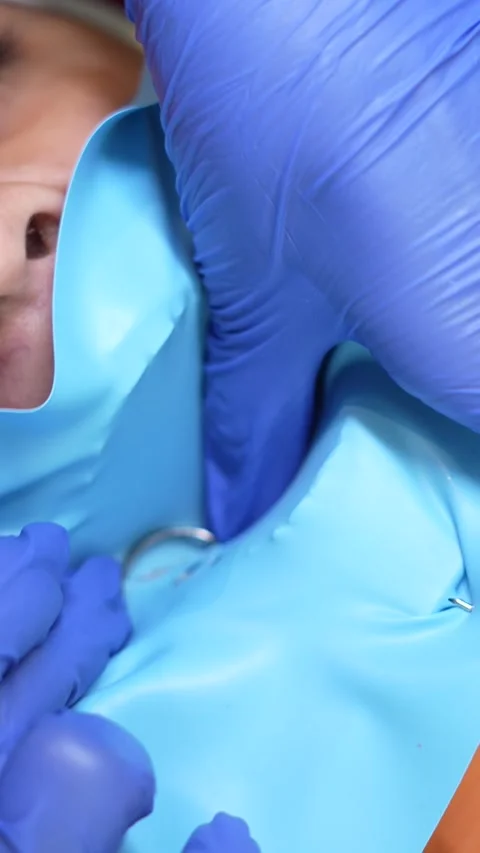 Dental Procedure with Rubber Dam Stock Footage 316914662
