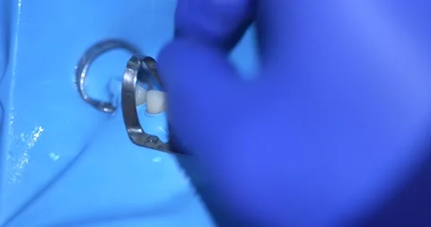 Dental Procedure Setup Stock Footage 316916922