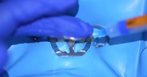 Dental Procedure with Syringe Stock Footage 316916667