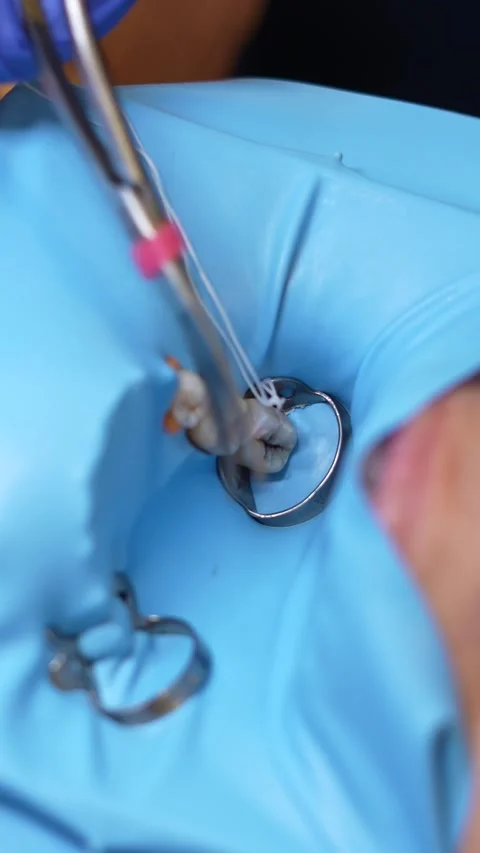 Dental Procedure Using Tweezers Stock Footage 316915480