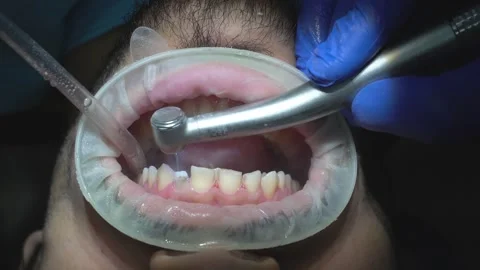 Dental Procedures in Action Video stock 316913650