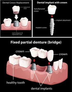 Dental procedures on black Illustrazione stock