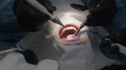 Dental professionals performing a prophylactic cleaning procedure using an air 스톡 동영상 339274048