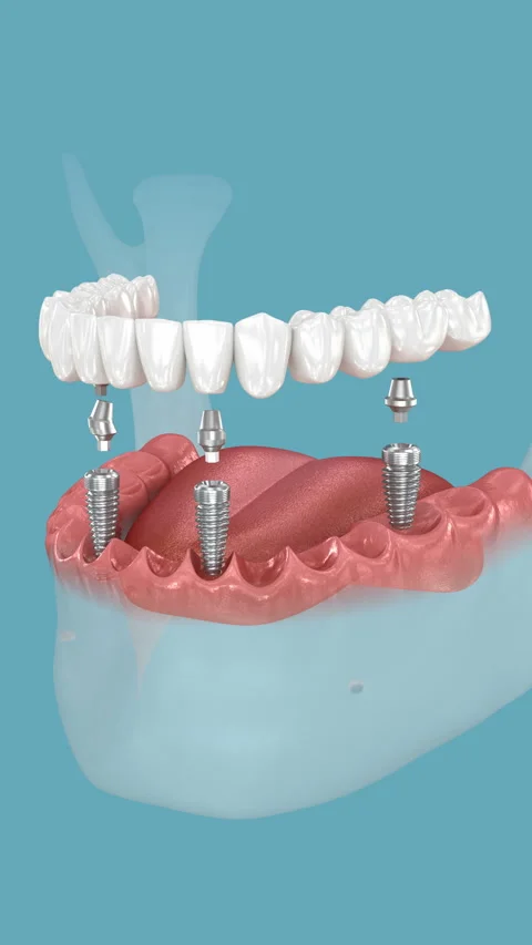 Dental prostheses supported by 4 implants. 3D animation Stock Footage 314537731