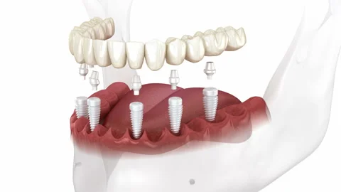Dental prosthesis based on 6 ceramic implants. Stock Footage 220927012