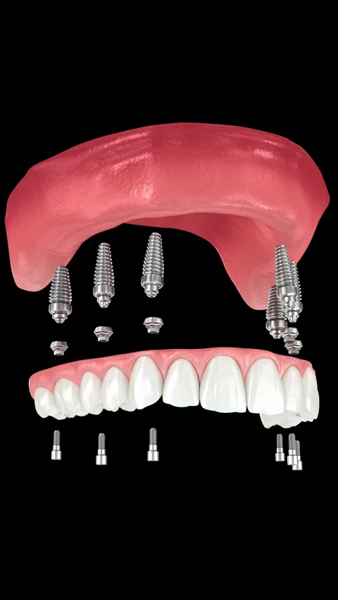 Dental prosthesis based on six implants. Dental 3D animation Stock Footage 247175445
