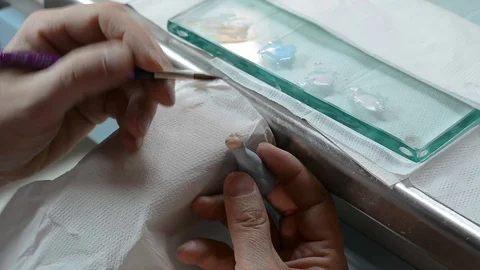 Dental prosthesis Stock Footage 100671553