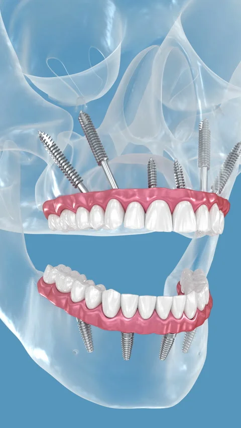 Dental prosthesis supported by zygomatic implants. 3D illustration Stock Footage 314537984