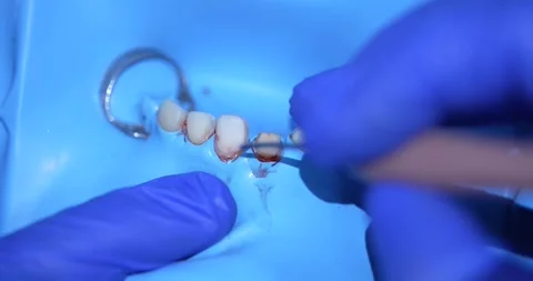 Dental Prosthetics Adjustment Stock Footage 316916943