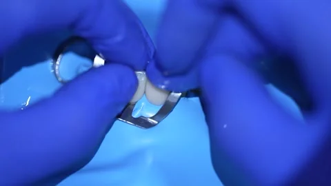 Dental Prosthetics Procedure Stock Footage 316917442