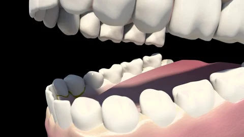 Dental Scaling Stock-Footage 121359364