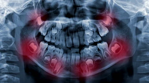 Dental scan x-ray digital footage Stock Footage 68637825