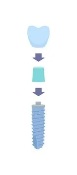 The dental scheme with arrows as a crown is installed on the abutment, and then Stock Illustration