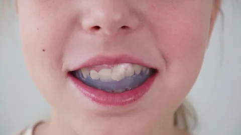 Dental simulator for teeth alignment . The child has mouth guards on his teeth. Stock Footage 303964693