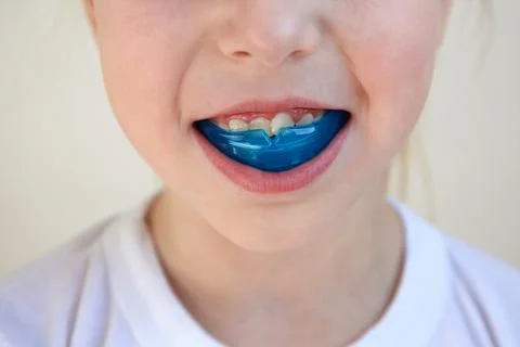 Dental simulator for teeth alignment . The child has mouth guards on his teet Stock Photos