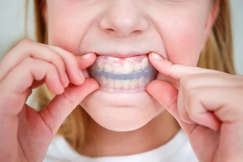Dental simulator for teeth alignment . The child has mouth guards on his teet Stock Photos