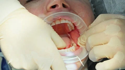 A dental surgeon checking the position of a parallel pin in the jawbone Stock-Footage 342079712