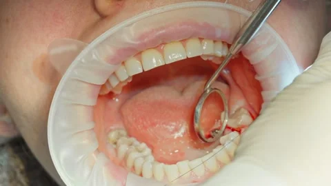 Dental surgeon closes the gum with threads after installing a dental implant Stock Footage 342079669