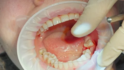 Dental surgeon stitches the gum with threads after installing a dental implant Video stock 342079925
