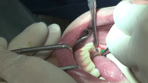 Dental surgery #1 Stock Footage 58461462