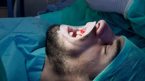 Dental Surgery 1 Stock Footage 111465664