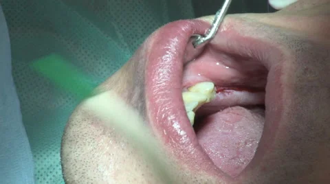 Dental surgery #2 Stock Footage 58456588