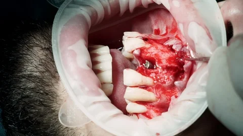 Dental Surgery 2 Stock Footage 111466482
