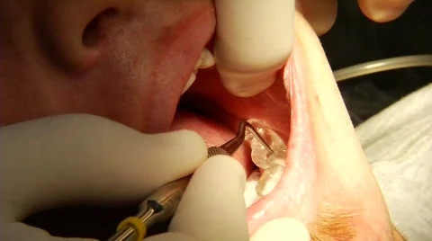 Dental Surgery 20 Stock Footage