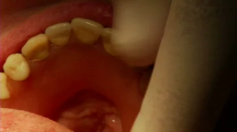 Dental Surgery 23 Stock Footage 732176