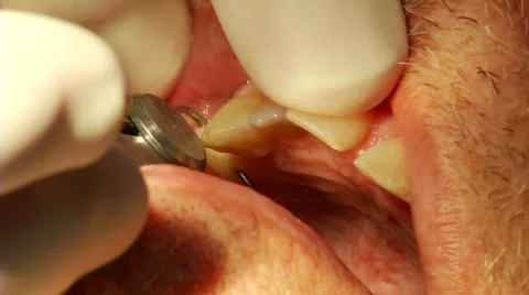 Dental Surgery 24 Stock Footage