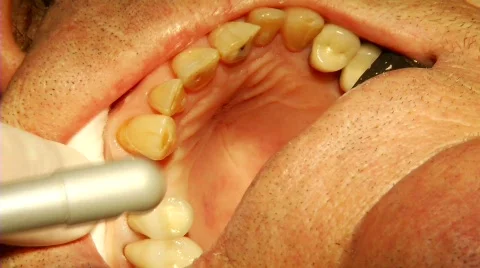 Dental Surgery 4 Stock Footage