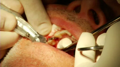 Dental Surgery 5 Stock Footage