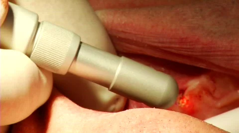 Dental Surgery 7 Stock Footage 732240