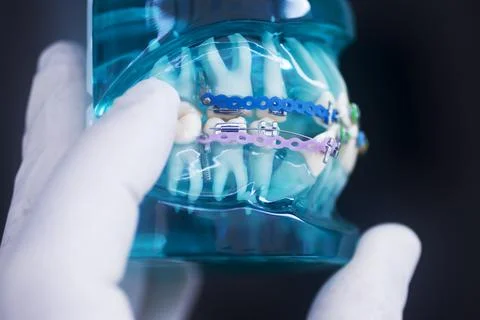 Dental teeth aligners brackets Stock Photos