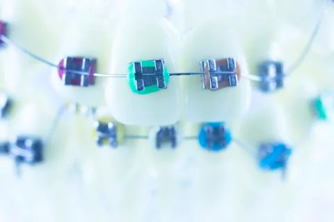 Dental teeth brackets aligners Stock Photos