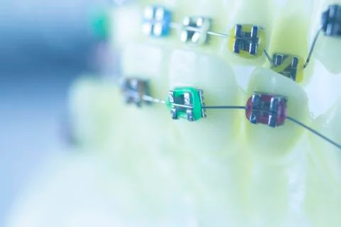 Dental teeth brackets aligners Stock Photos