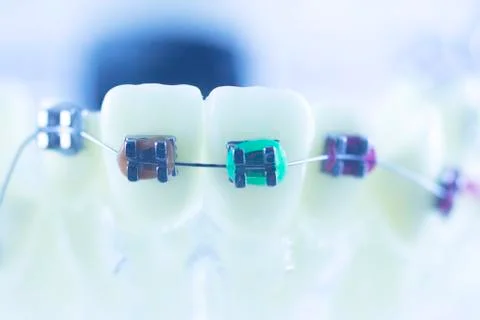Dental teeth brackets aligners Stock Photos