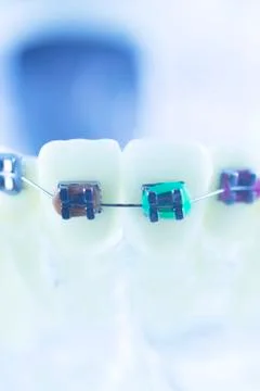 Dental teeth brackets aligners Stock Photos