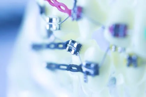 Dental teeth brackets aligners Foto stock