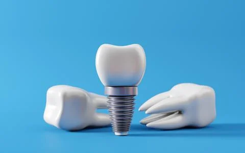 Dental teeth implants and Root caries. Oral health and dental inspection te.. Stock Illustration