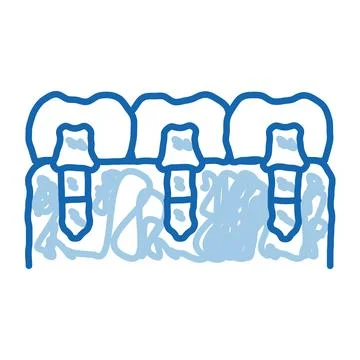 Dental Teeth Implants Biomaterial doodle icon hand drawn illustration Illustrazione stock