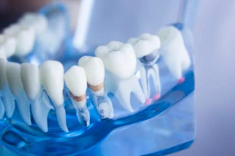 Dental teeth plaque model Stock Photos