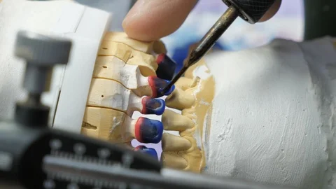 Dental teeth restoration procedure  Stock Footage 99890950